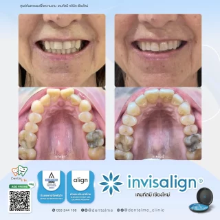 รีวิวจัดฟันใส Invisalign เคสผู้ใหญ่ ก่อนและหลังการรักษาที่ Dentalme คลินิก เชียงใหม่