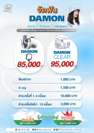 ราคาแพ็กเกจจัดฟัน Damon และ Damon Clear เดนทัลมี คลินิก เชียงใหม่ พร้อมรายละเอียดค่ารักษา