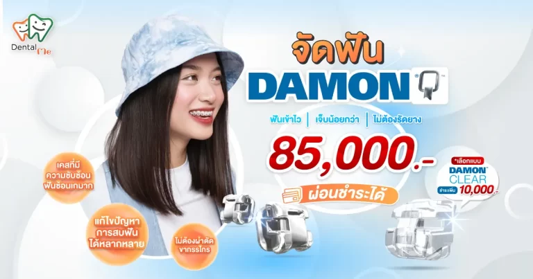 จัดฟัน Damon เชียงใหม่ เดนทัลมี คลินิก ราคาเริ่มต้น 85,000 บาท ฟันเข้าไว เจ็บน้อยกว่า ไม่ต้องรัดยาง