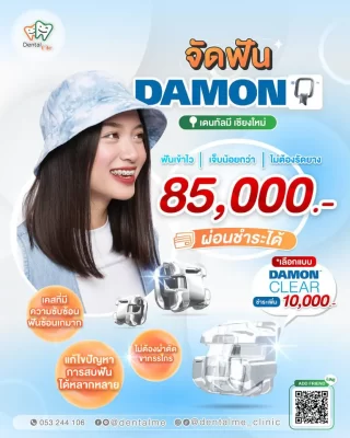 จัดฟัน Damon Clear เชียงใหม่ เดนทัลมี คลินิก ราคา 85,000 บาท ตัวเลือกใส ไม่ต้องรัดยาง ฟันเข้ารวดเร็ว