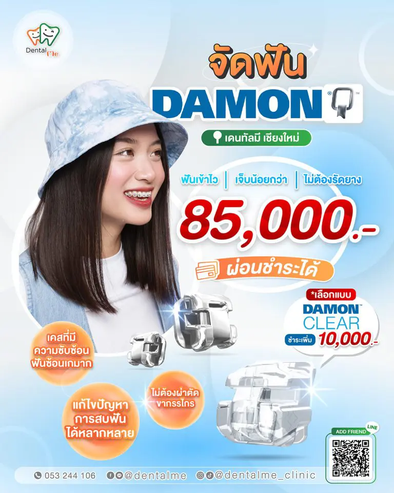 จัดฟัน Damon Clear เชียงใหม่ เดนทัลมี คลินิก ราคา 85,000 บาท ตัวเลือกใส ไม่ต้องรัดยาง ฟันเข้ารวดเร็ว