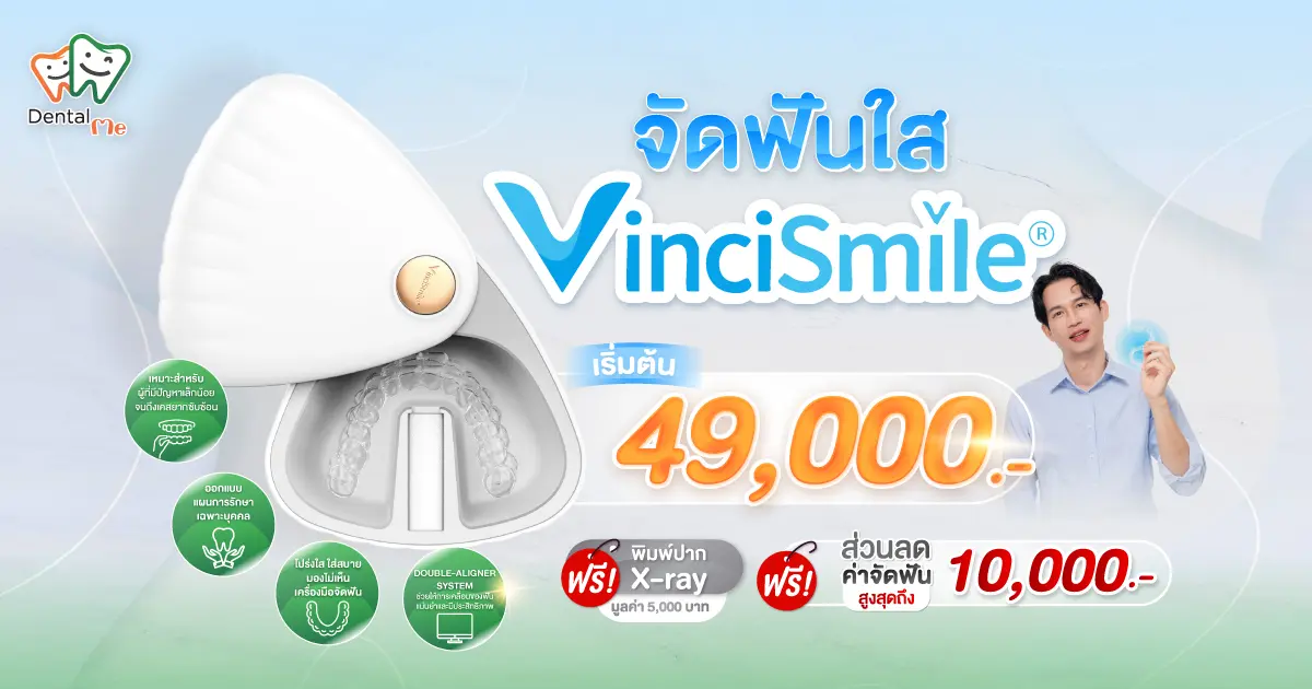 จัดฟันใส VinciSmile เชียงใหม่ เริ่มต้น 49,000 บาท ฟรีพิมพ์ปาก X-ray และส่วนลดค่าจัดฟัน
