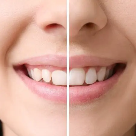 วีเนียร์ เชียงใหม่ – Dentalme Clinic