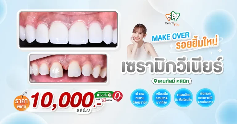 veneer-promotion-cover